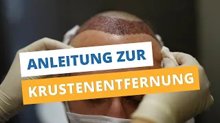 Krusten entfernen nach Haartransplantation ►Anleitung zur Krustenentfernung ◄