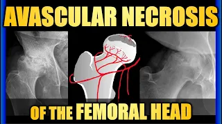 Avascular Necrosis of the Femoral Head #hippain #trauma #radiology