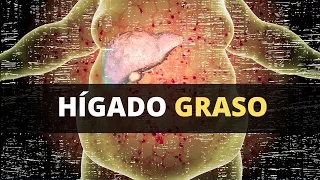 Hígado graso - lo que debes de saber (diagnóstico, síntomas, tratamiento y prevención)