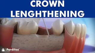 Dental crown lengthening ©