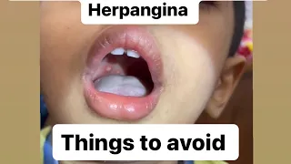 Hand foot and mouth disease / HERPANGINA: most important thing to avoid