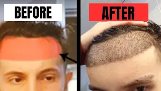 Low Hairline Hair Transplant Big Mistake? Hattingen Hair Reacts