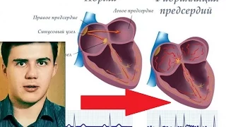 ФИБРИЛЛЯЦИЯ ПРЕДСЕРДИЙ. Классификация. Этиология