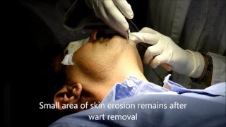 Wart removal by RF Cautery