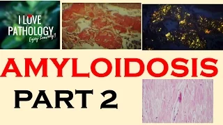 AMYLOIDOSIS: PART 2: Pathogenesis & Classification