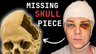 Health Update: My Skull-less Head + Scary Brain Infection | GoForBrandon