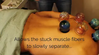Fire cupping demo on back