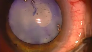 Surgery: Achieving Excellence in Cataract