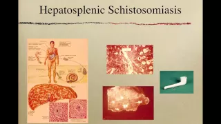 Ultrasound for Schistosomiasis