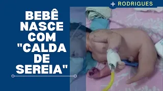 Bebê sereia’ nasce na Índia com 'cauda' e atrai multidão a hospital