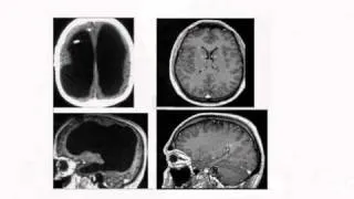 The Man With No Brain: Brain Adaptation and Self-Repair - by Professor Keith Kendrick