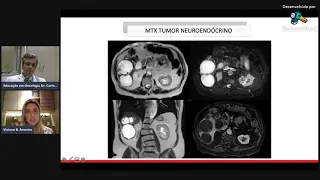 RADIOLOGIA OS TUMORES MALIGNOS DO FIGADO E DAS VIAS BILIARES. - Dra Viviane Amorim