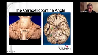 The Retrosigmoid Surgical Approach to Treat Acoustic Neuromas