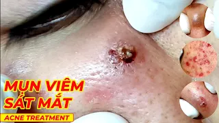 Điều trị mụn ngay sát mí mắt | Pixel Master | Acne Treatment | Hiền Vân spa | HV Clinic | 702