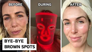 Is cosmelan the secret to clearing melasma and dark spots? My chemical peel transformation