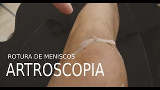 Día 17:  Operación de Rodilla (artroscopia), rotura de menisco asa de cubo (Mi experiencia)