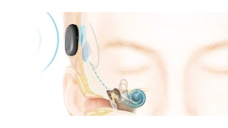 How the Cochlear™ Nucleus® Kanso™ Implant System Works