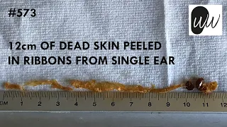 573 - 12cm of Dead Skin Peeled in Ribbons from Single Ear