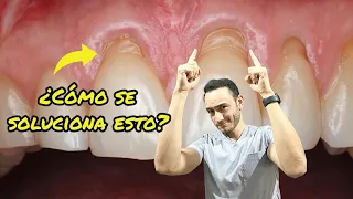 Así se solucionan las encías retraídas (recesión gingival)