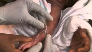 Newborn Care Series: Inserting an IV