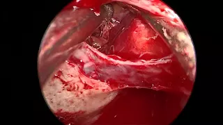 cavernous sinus invading tumor