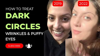 How to treat dark circles, under eye wrinkles, puffy eyes and hallow under eyes