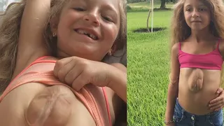 Rare condition: Girl born with heart outside chest; Swollen head baby; Tree man disease- Compilation