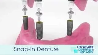 Demo: How Do Snap-In Dentures With Implants Work?