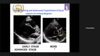 Premature Ventricular Contraction - Evolution and Management -Dr.Narasimhan-DAY1-CHRS-5th EP UPDATE