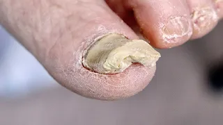 Super Thick RARE WHITE TOENAIL?!