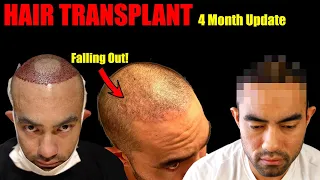My Hair Transplant Results After 4 Months | Hair Falling Out