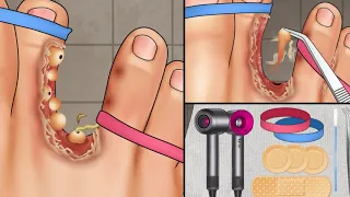 ASMR Remove Fungal Infaction Between Toes | Foot Care Treatment Animation |Satisfaction O