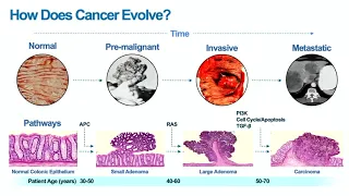 Seminar Clips: Early Detection of Cancer Mutations- Luis Diaz, MD | Stanford Cancer Institute