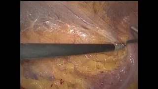 Laparoscopic left Nephrectomy with Harmonic  Лапароскопическая нефрэктомия слева