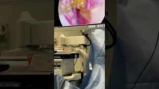 Video Trattamento REZUM per Ipertrofia Prostatica Benigna