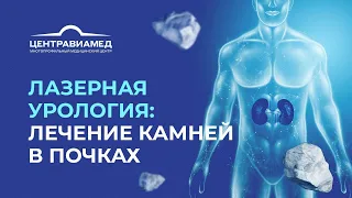 Лазерное дробление камней в мочеточнике