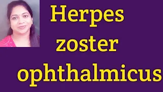 Herpes Zoster Ophthalmicus// Hutchison's rule//Post herpetic neuralgia// Treatment of Herpes Zoster