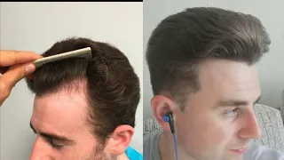 Hairline Before a Hair Transplant