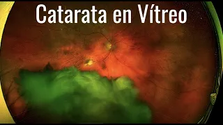 Resolución de Catarata Caída en Vítreo.