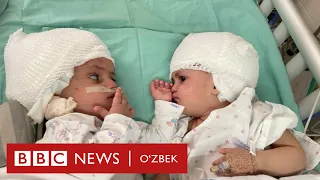 Боши қўшилган эгизаклар қандай ажратилди? Дунё, янгиликлар BBC News O'zbek