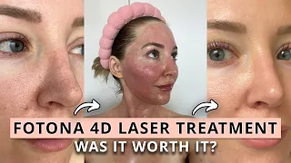 Was the Fotona 4D Laser Treatment Worth It? Before & After