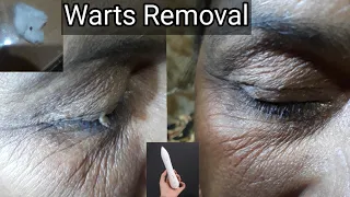 cautery laser pen / warts /mole removal / painless warts removal