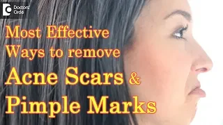 How to get rid of acne scars and pimple marks? - Dr. Chitrika. G. B