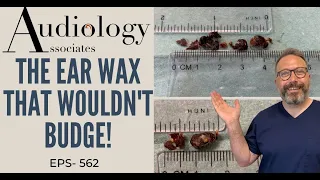 THE EAR WAX THAT WOULDN'T BUDGE - EP562