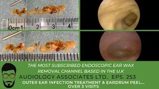 OUTER EAR INFECTION TREATMENT & EARDRUM PEEL OVER 3 VISITS - EP 253