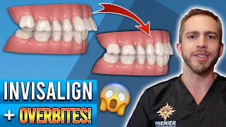 Invisalign Overbite Treatment! [BEFORE & AFTER]