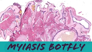 Botfly larva (fly maggot) in skin (myiasis pathology dermpath dermatology dermatopathology)