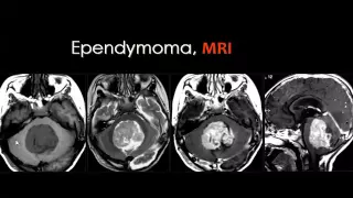 Imaging of Intraventricular lesions of the brain   Prof Dr  Mamdouh Mahfouz In Arabic