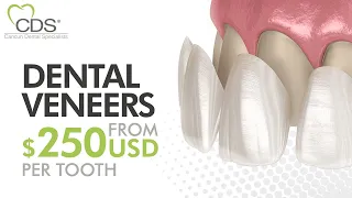 What Are Dental Veneers And How Much Do They Cost? | Cosmetic Dentistry