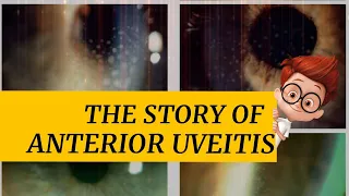 The story of ANTERIOR UVEITIS || iritis ,cyclitis and iridocyclitis || Signs & symptoms and more..